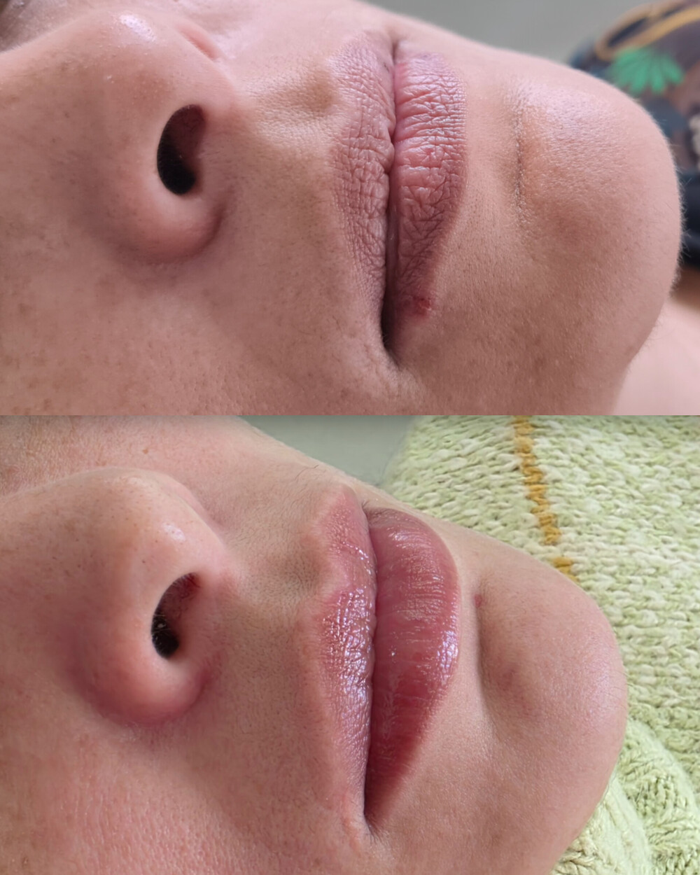 Resultado de preenchimento labial - antes e depois