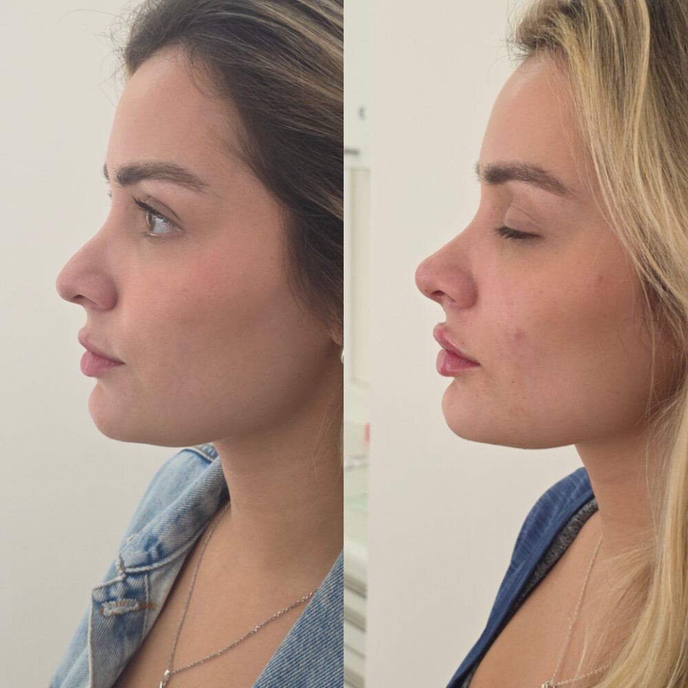 Resultado de rinomodelação e preenchimento labial - antes e depois